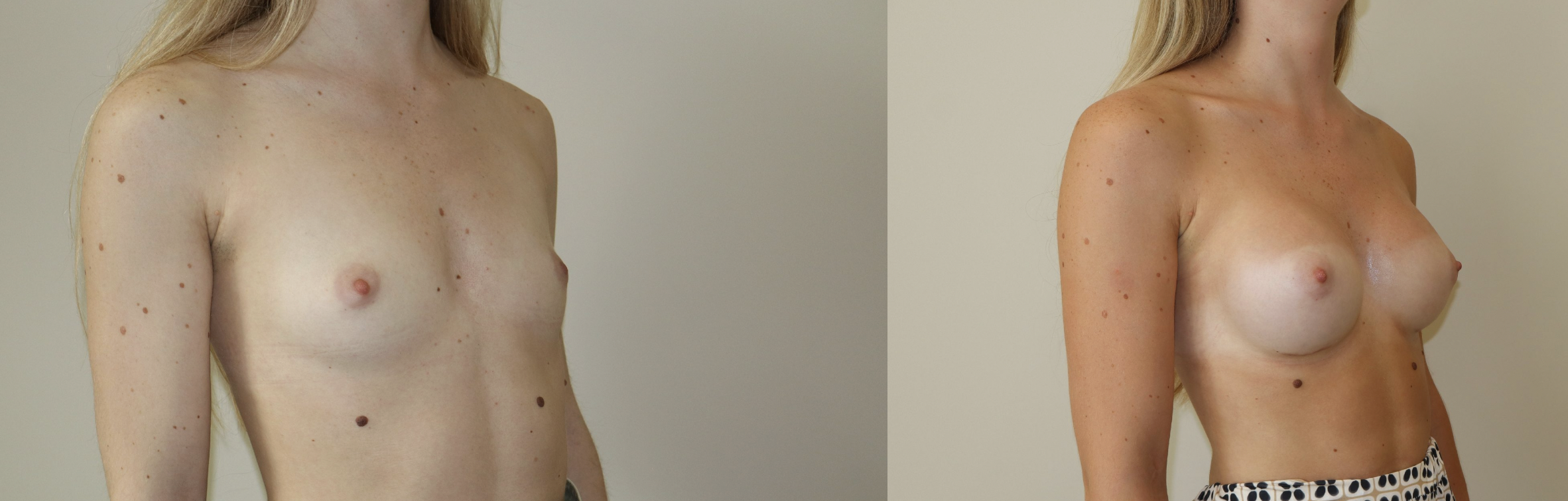 Avant/Après prothèses mammaires